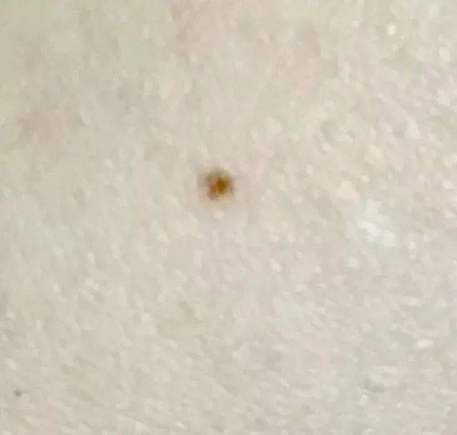 痣的分类注意事项及恶变预防