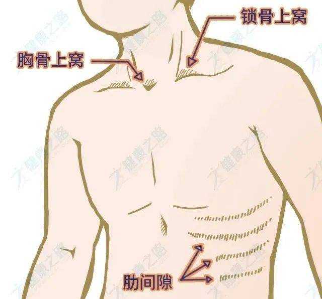 如果出现面色晦暗,嘴唇发绀和呼吸三凹征(吸气时胸骨上窝,锁骨上窝,肋