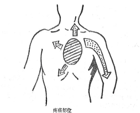 心肌梗塞的病理症状