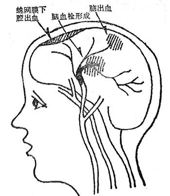 中风是怎么回事