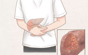 肝功能异常的原因、表现及如何预防