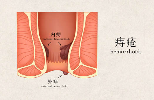 痔疮
