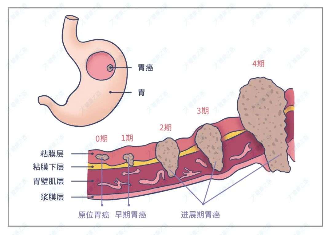 进展期（中期）胃癌