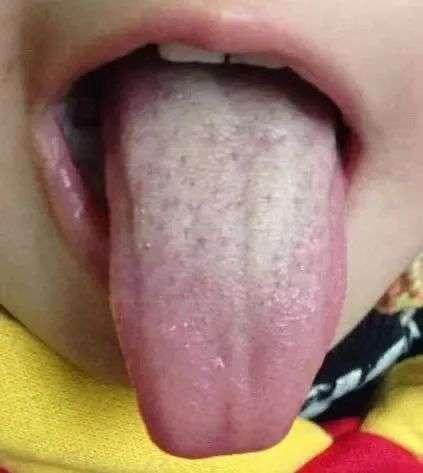 厚腻舌苔