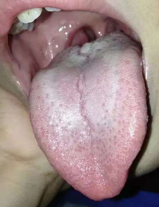 舌苔中间有裂缝