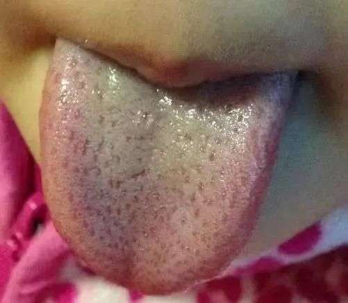 腻舌苔