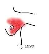 消乳汤治疗乳腺炎医案