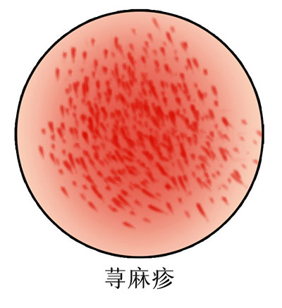 荨麻疹
