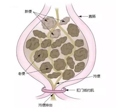 功能性便秘