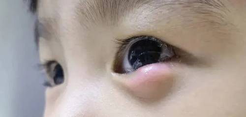 中医治疗霰粒肿医案分享