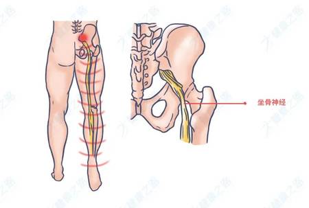 小儿坐骨神经的部位图图片