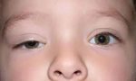 孩子大小眼是什么原因？要不要紧？