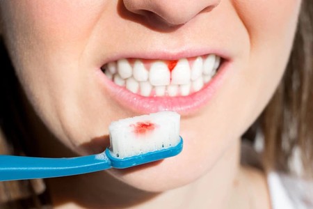 如何预防和治疗牙龈炎